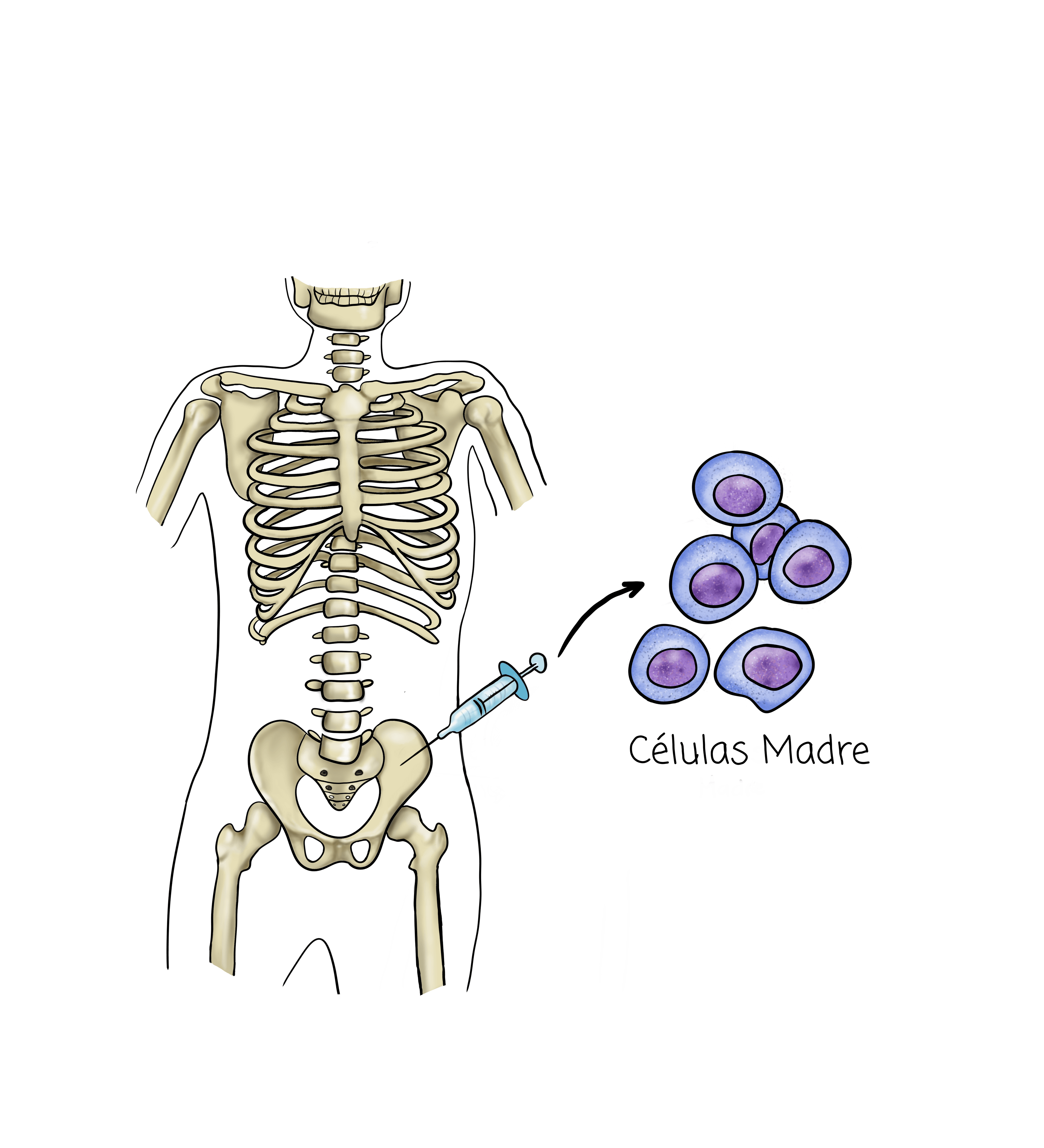 Medical team performing a bone marrow transplant procedure