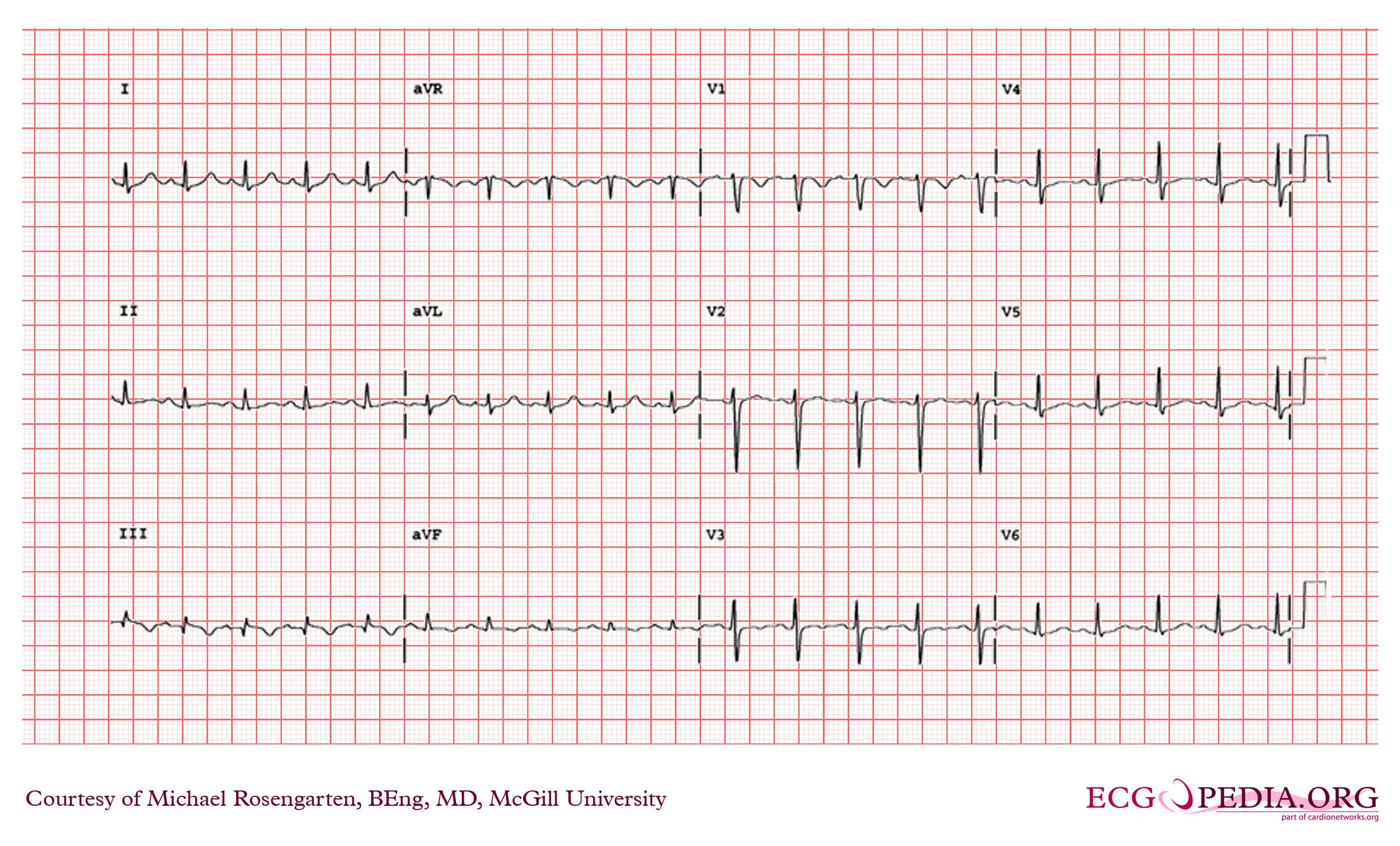 Electrocardiogram tracing showing heart rhythm